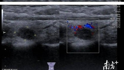 从东北到梅州,跨越3000公里的求医之路……