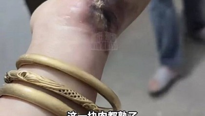 手被烧熟！金手镯被烧熔！女子给电动车充电，不慎碰到充电口受伤
