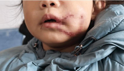 网曝巴中1岁10个月女童被狗咬伤脸部 父亲:已报警,将寻找狗主人追责到底